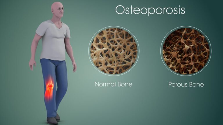 Build Unbreakable: Power Up Your Bones Now to Beat Osteoporosis Later