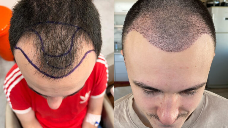Dark Clinics and Hair Transplants: The Red Flags in 2026