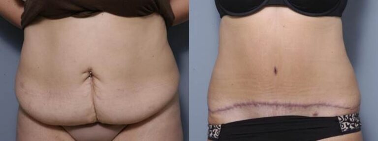 Cosmetic Surgery is Rising in South Africa – But so are Problem Scars. SA Expert Explains why